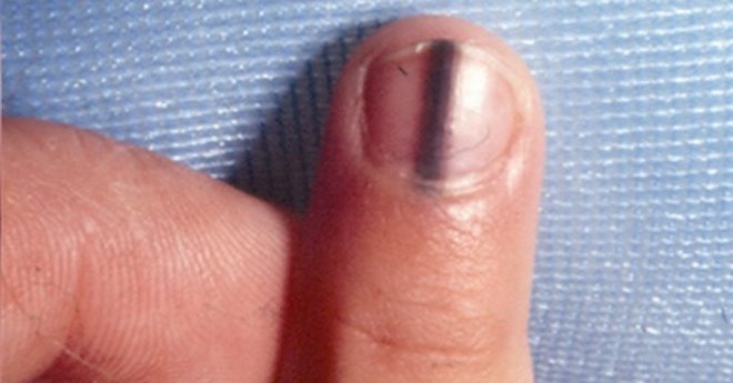 can-iron-deficiency-cause-black-lines-on-nails-design-talk